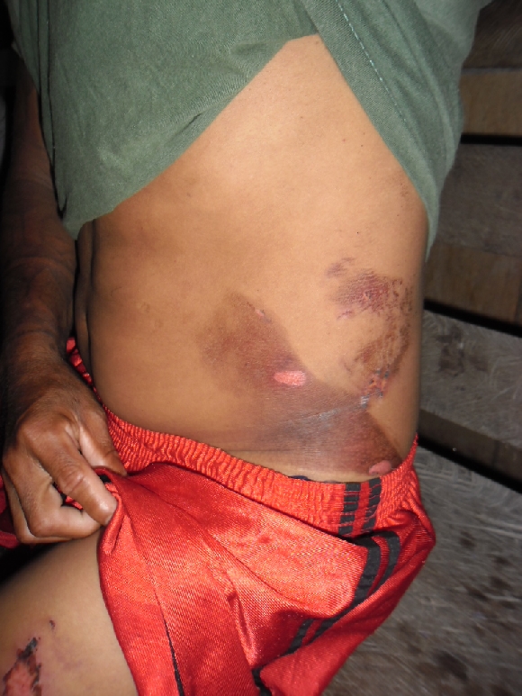 Indígena Munduruku mostra marcas de agressões da Polícia Federal resultado da Operação Eldorado