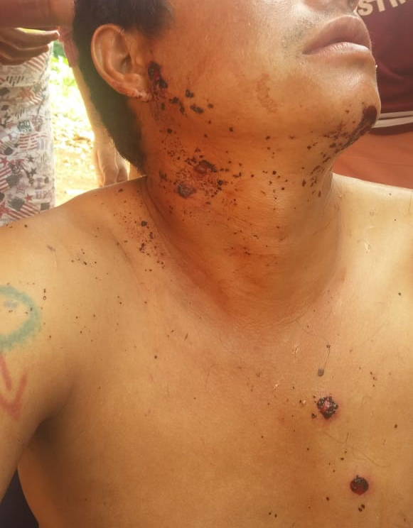 Guarani Kaiowá ferido durante ataques às retomadas em Dourados nos dias 2 e 3 de janeiro de 2020. Foto: povo Guarani e Kaiowá