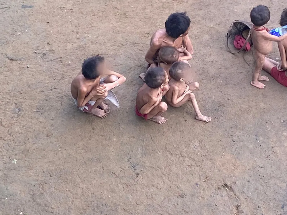 Crianças são as mais afetadas por doenças na Terra Indígena Yanomami. Foto: Condisi-YY/Divulgação